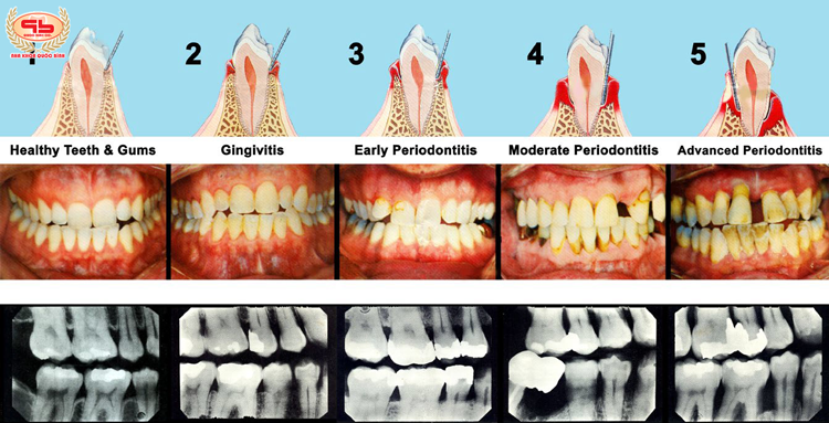 Don't confuse inflammatory gum disease with periodontitis