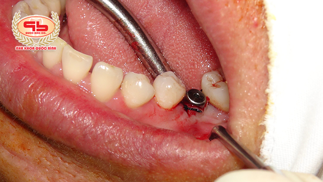 When is the right time for dental implants after tooth extraction?