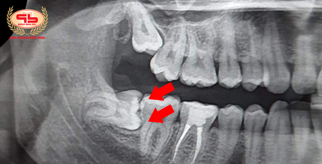 Horizontal wisdom teeth cause damage to neighboring teeth