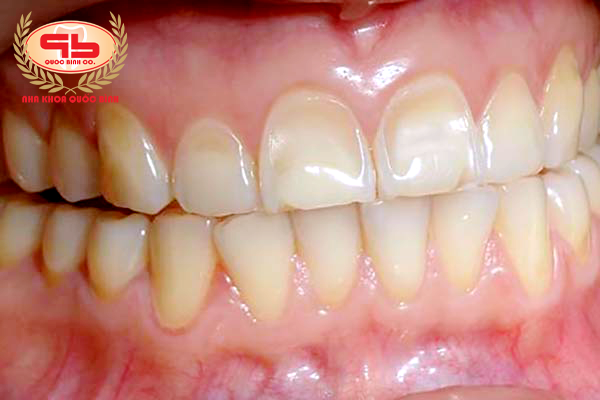 Erosion of teeth exposing dark yellow dentin