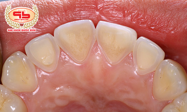 Tooth erosion wears away the enamel layer