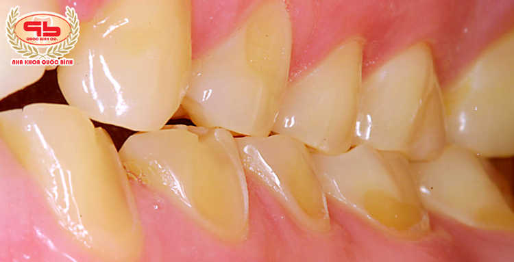 Tooth erosion - What you need to know!