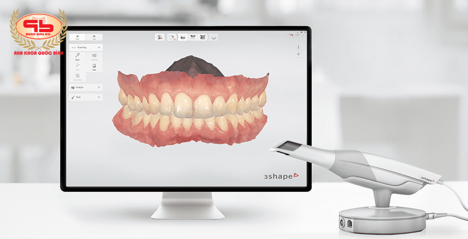 Có ngay kết quả lấy dấu hàm răng với máy quét 3D mẫu hàm hiện đại