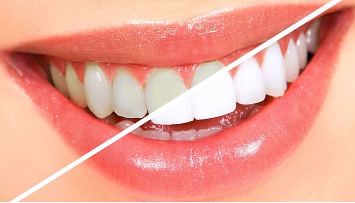 Tẩy trắng răng giúp lấy lại nụ cười tỏa sáng