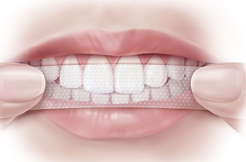 Tẩy trắng răng giúp lấy lại nụ cười tỏa sáng