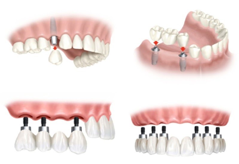 Trồng răng Implant - phục hồi hoàn hảo chiếc răng bị mất