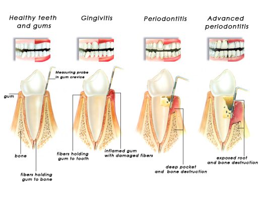 What do you know about periodontal disease?