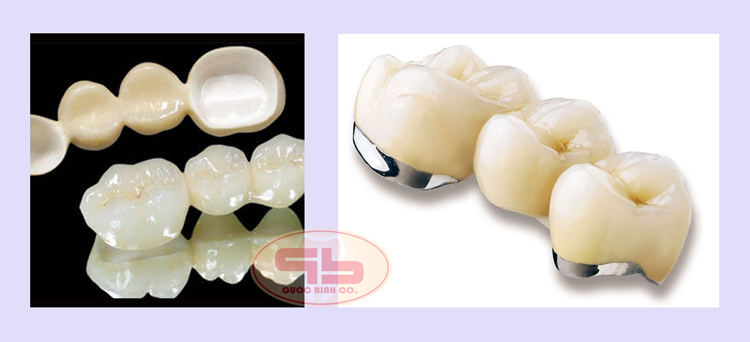 Is the dental metal porcelain bridge good?