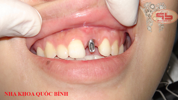 Abutment - Dental Implant procedure according to international standards