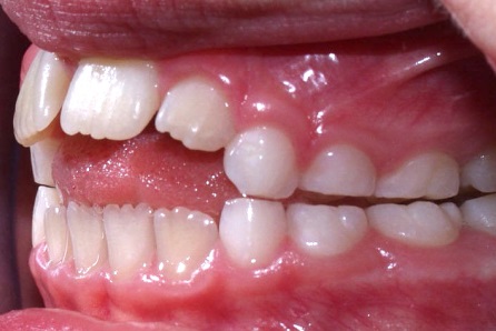 Do you know which cases should be orthodontic treated?