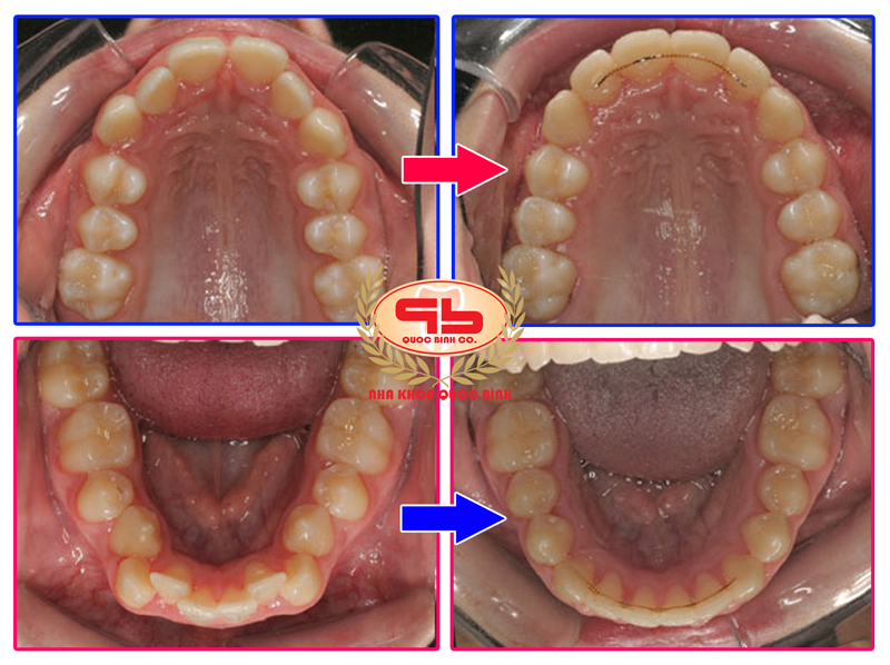 When does apply the braces without extraction tooth?
