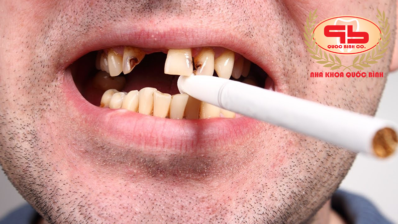 Tobacco smoking and the risk of dental implants failure.