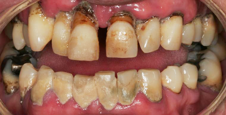Tobacco smoking and the risk of dental implants failure.
