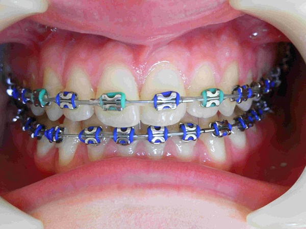 Braces with metal bracket bring outstanding orthodontic effect