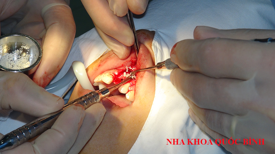 Jaw bone standard is suitable for dental implants