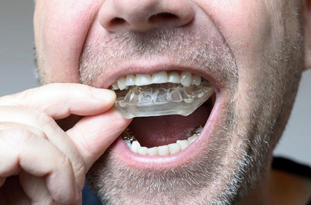 Máng chống nghiến răng 