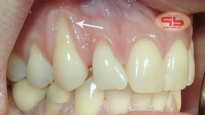 Teeth is sensitive due to gingival recession