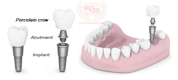 Dental implants integrate bone rapidly 