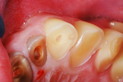 The abrasion of tooth surface due to the habit of grinding teeth