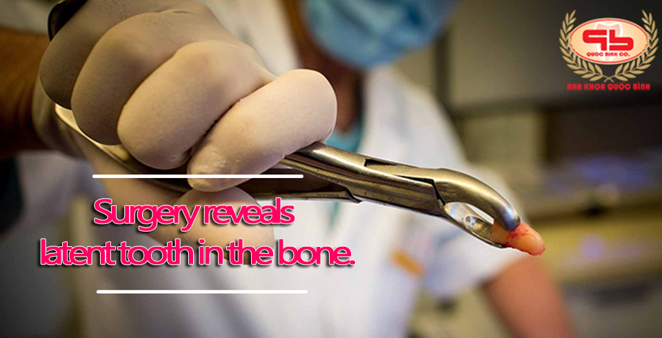 Surgery reveals latent tooth in the bone.