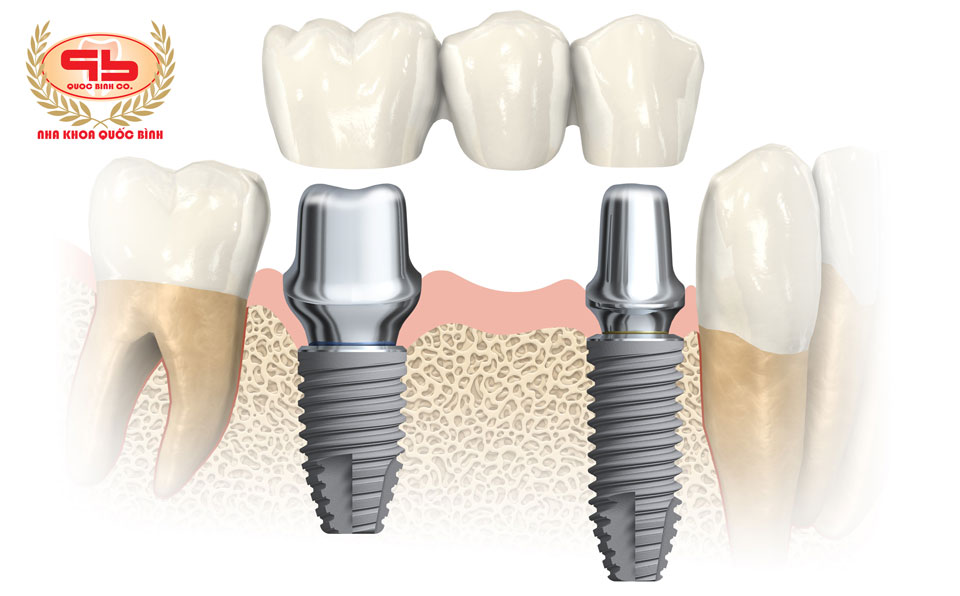 Implant dentures bridge