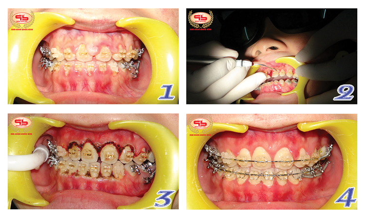 Laser in dentistry - the modern trend of nowadays