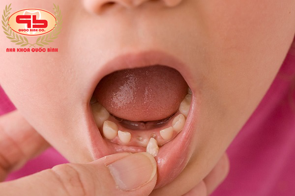 Should loose milk teeth be extracted?