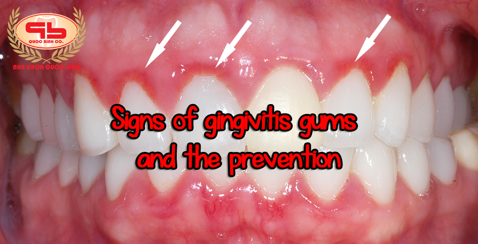 Signs of gingivitis easy to identify and prevent.
