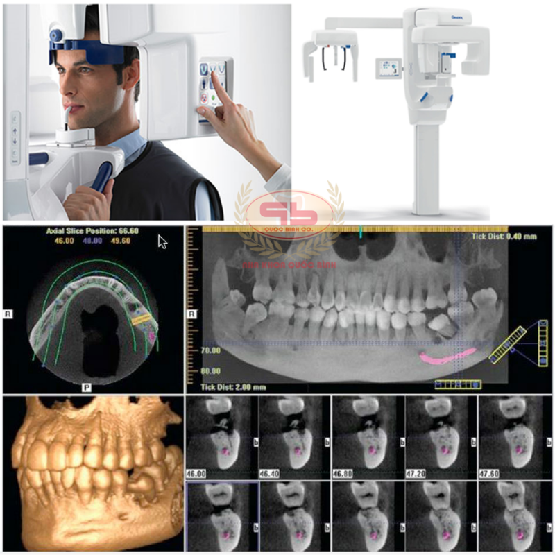 Có cần thiết chụp CT Cone beam trước khi làm Implant?