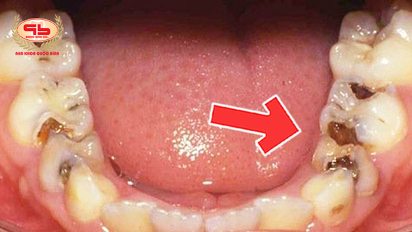 Sâu kẻ răng và điều trị hiệu quả như thế nào?