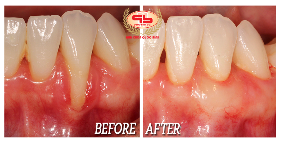 Gingival graft surgery to treat gums recession to expose the tooth's neck