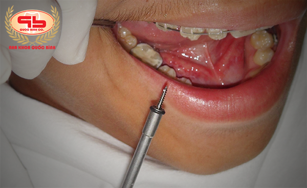 Notes when treating braces with minivis