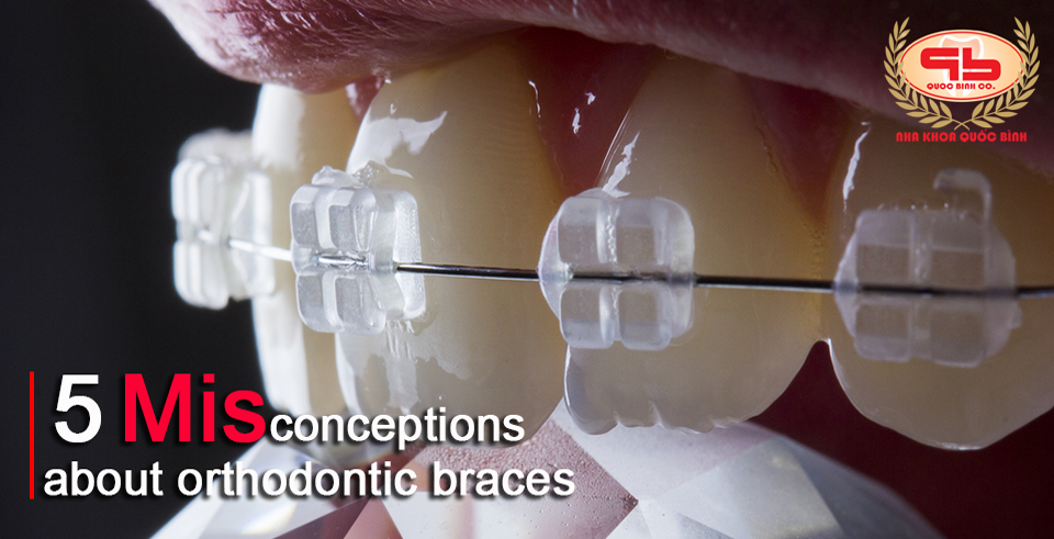 5 Misconception about braces that many people often mistakenly believe