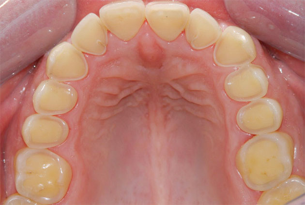 The inappropriate quality of porcelain crown causes the chewing surface of real teeth to wear.