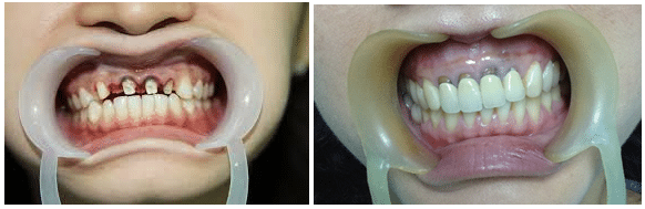 Một số ảnh hưởng đến răng thật khi chất lượng răng sứ không đảm bảo