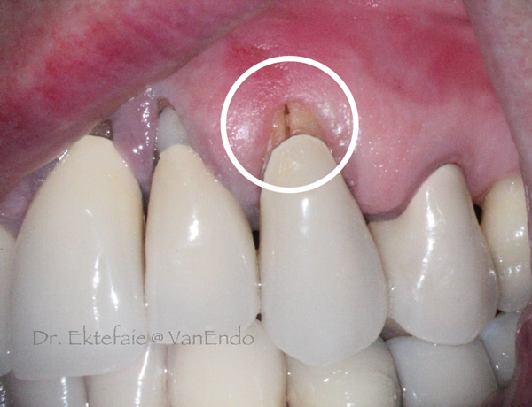 Some effects on real teeth when the quality of porcelain crown is not guaranteed