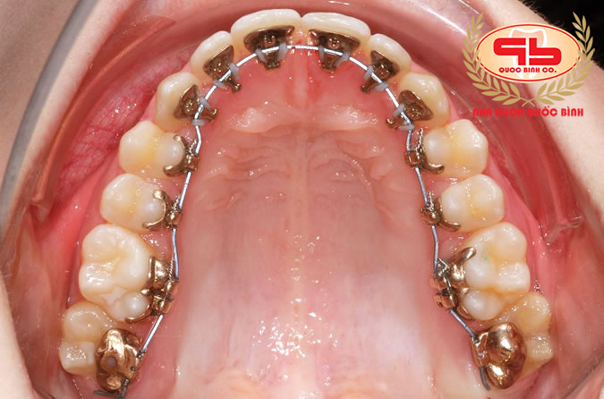 Brackets attached to the inside of the teeth