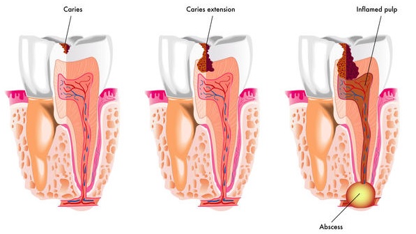 Tooth decay