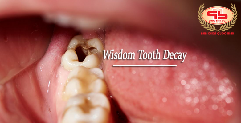 what-to-do-when-having-a-wisdom-tooth-decay