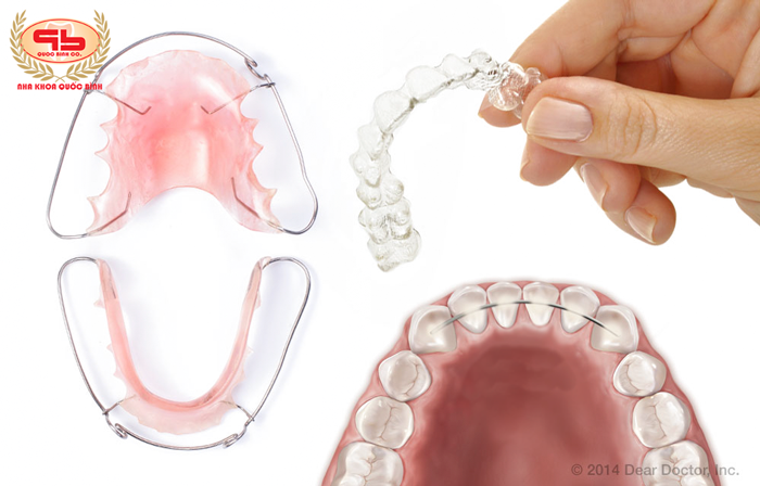 Is the retainer jaw after orthodontics important?