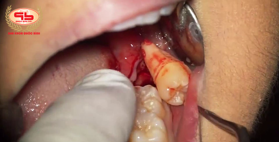 Bleeding after wisdom teeth extraction, is it normal?