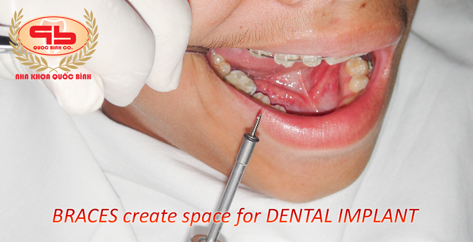 braces create space for dental implants