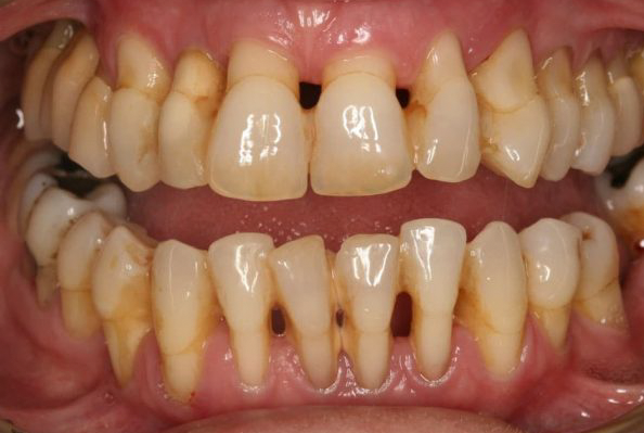 What is the treatment for periodontitis?