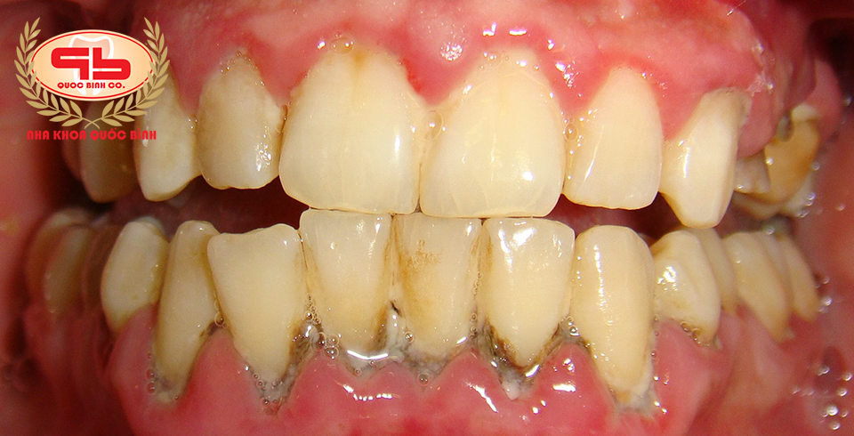What is the treatment of periodontitis?