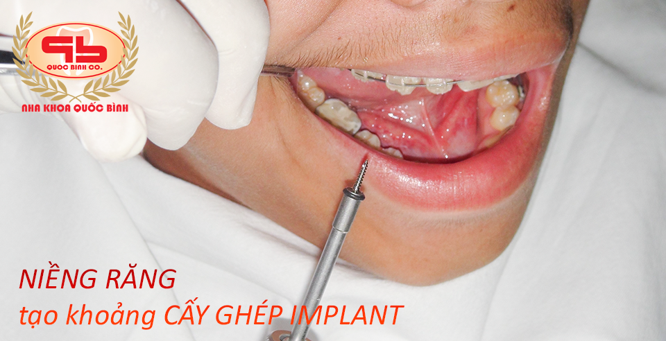 Niềng răng tạo khoảng cấy ghép Implant