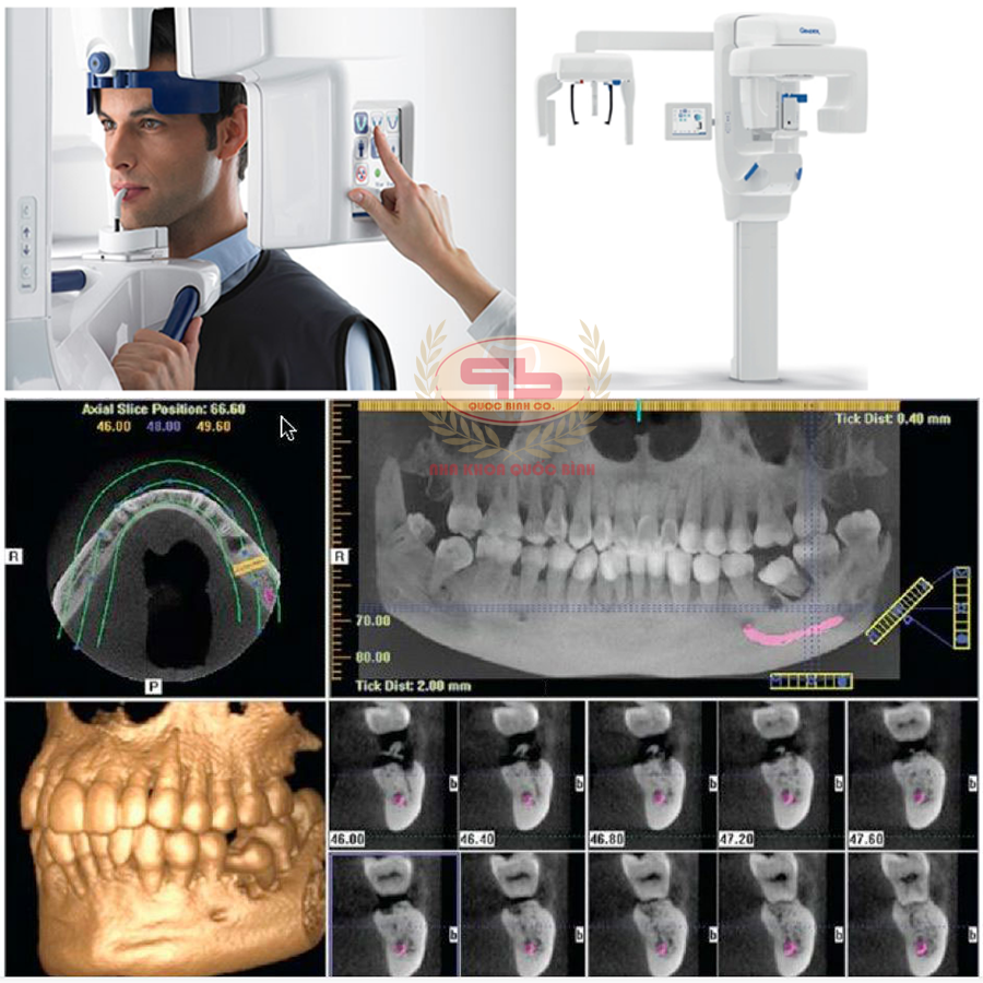 Máy CT cone beam giúp nâng cao chất lượng trồng răng Implant