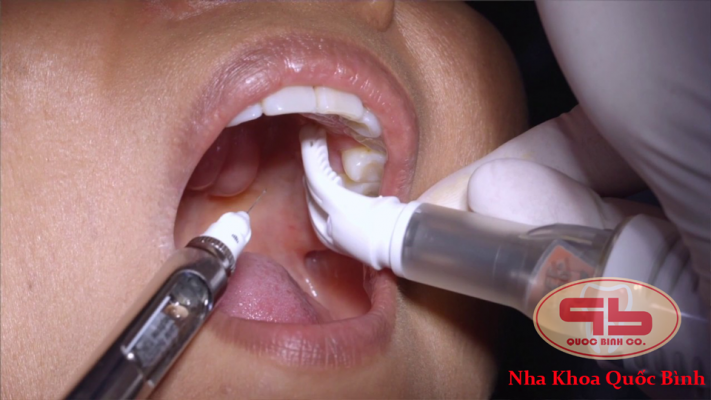 Tiêm thuốc tê khi nhổ răng không đau nhờ thiết bị Dentalvibe