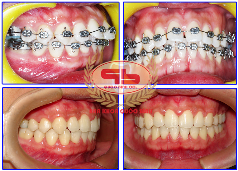 Is incisors braces difficult?
