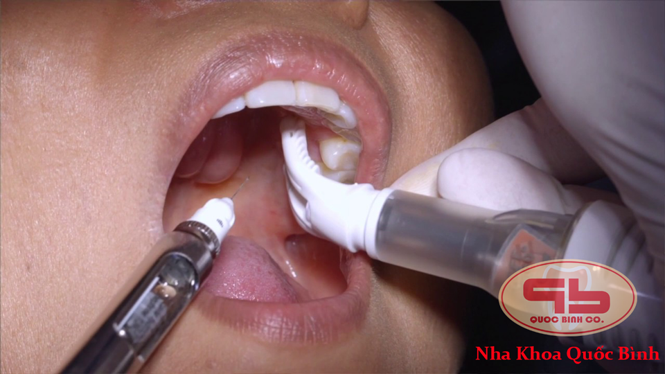 Injecting anesthetic when tooth extraction is painless thanks to the Dentalvibe device