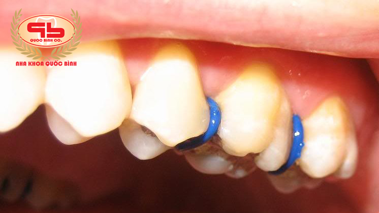 Giai đoạn đặt thun tách kẻ răng có thể làm bạn thấy nhức âm ỉ